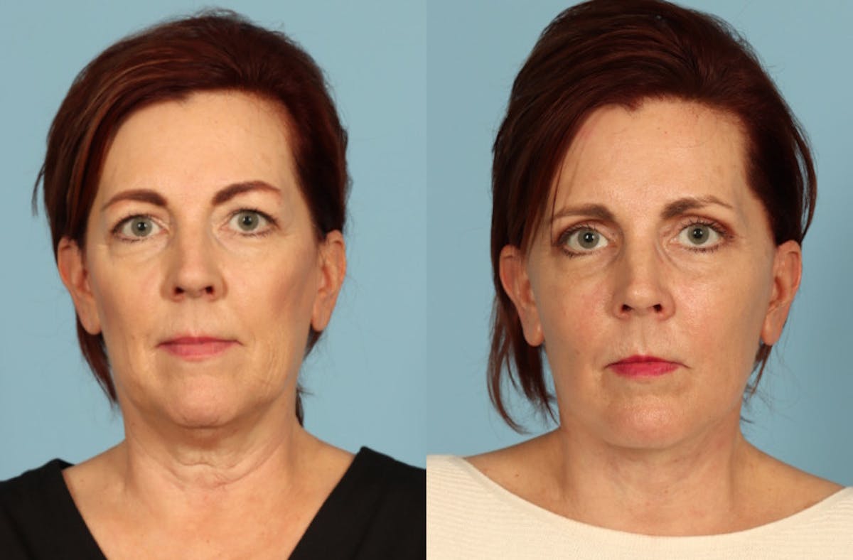 Neck Lift Before & After Gallery - Patient 117229 - Image 5