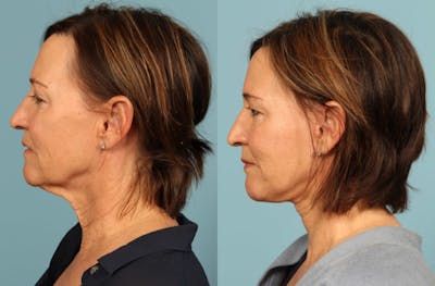 Neck Lift Before & After Gallery - Patient 137473 - Image 1
