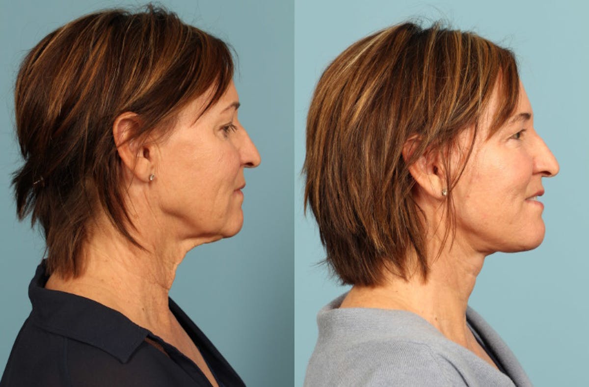 Neck Lift Before & After Gallery - Patient 137473 - Image 2