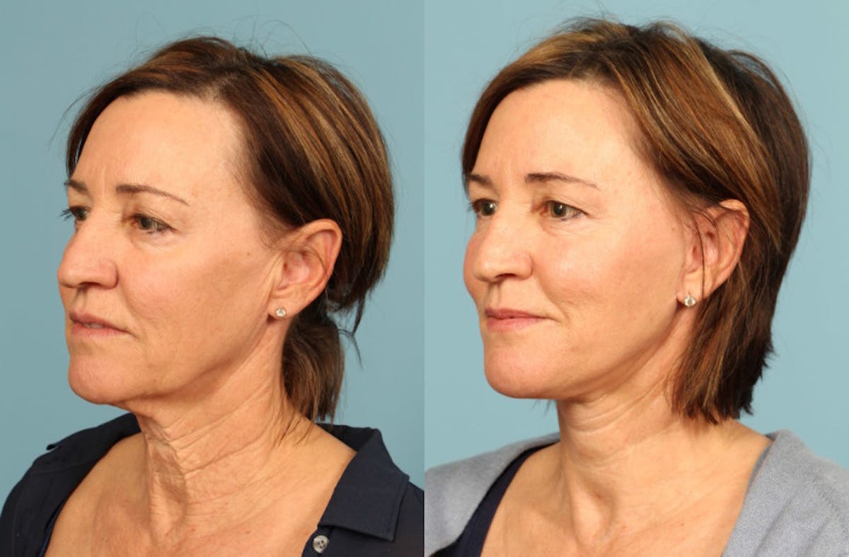 Neck Lift Before & After Gallery - Patient 137473 - Image 3