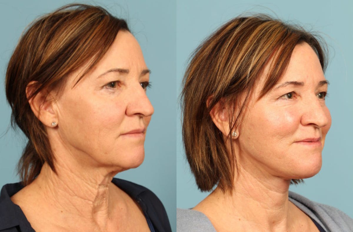 Neck Lift Before & After Gallery - Patient 137473 - Image 4