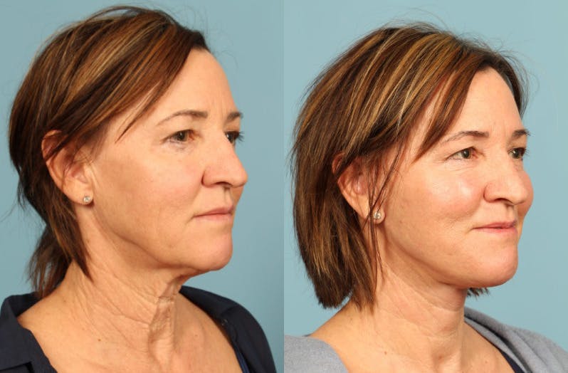 Neck Lift Before & After Gallery - Patient 137473 - Image 4