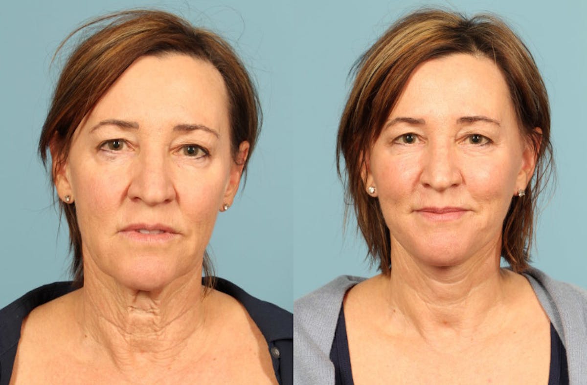 Neck Lift Before & After Gallery - Patient 137473 - Image 5