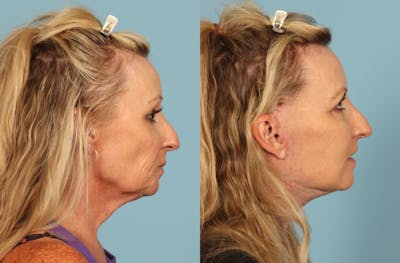 Neck Lift Before & After Gallery - Patient 391991 - Image 1
