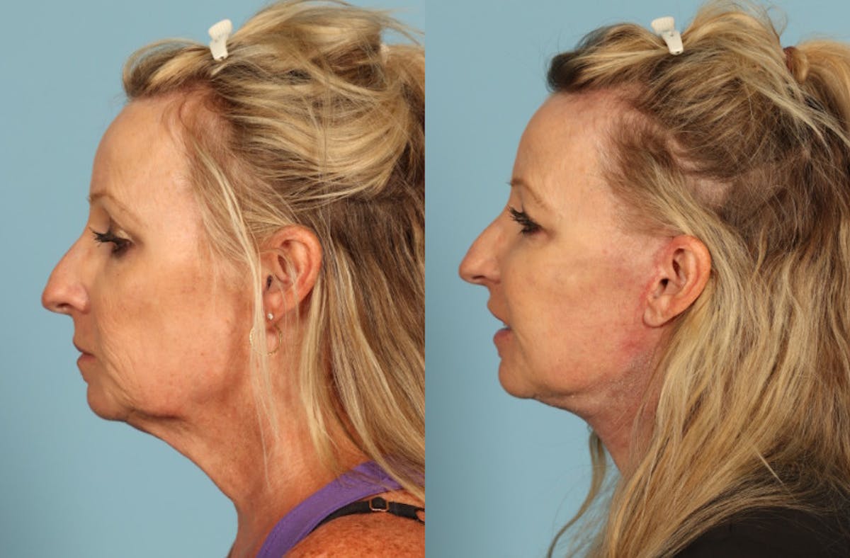 Neck Lift Before & After Gallery - Patient 391991 - Image 2