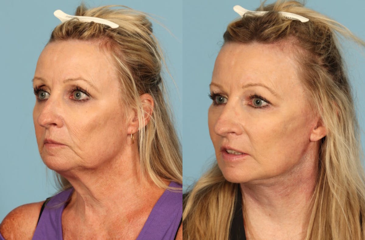 Neck Lift Before & After Gallery - Patient 391991 - Image 4