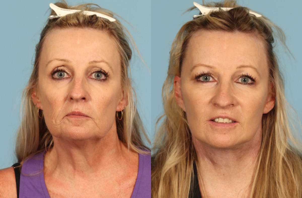 Neck Lift Before & After Gallery - Patient 391991 - Image 5