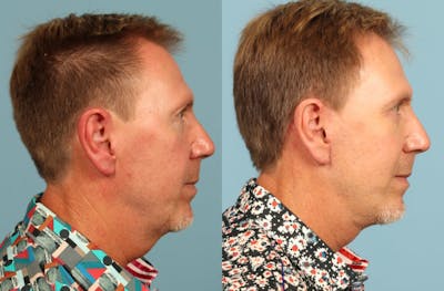 Neck Lift Before & After Gallery - Patient 293652 - Image 1