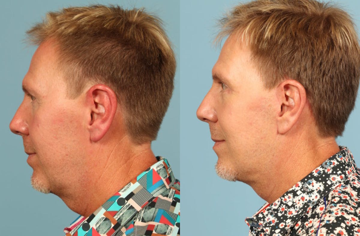 Neck Lift Before & After Gallery - Patient 293652 - Image 2