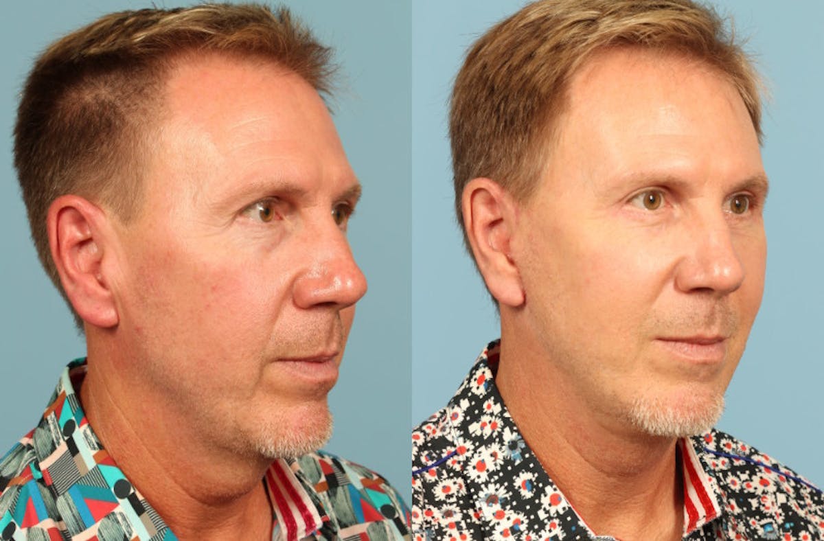 Neck Lift Before & After Gallery - Patient 293652 - Image 3