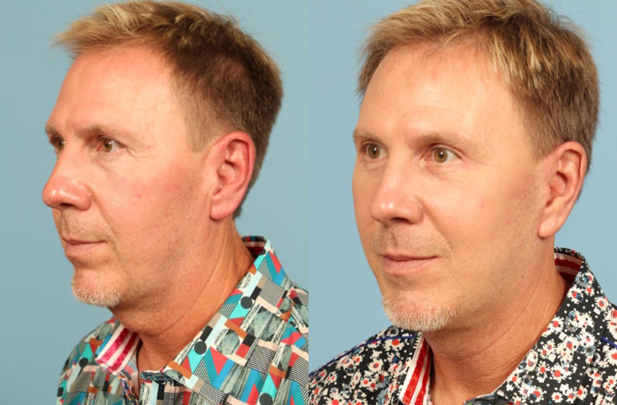 Neck Lift Before & After Gallery - Patient 293652 - Image 4