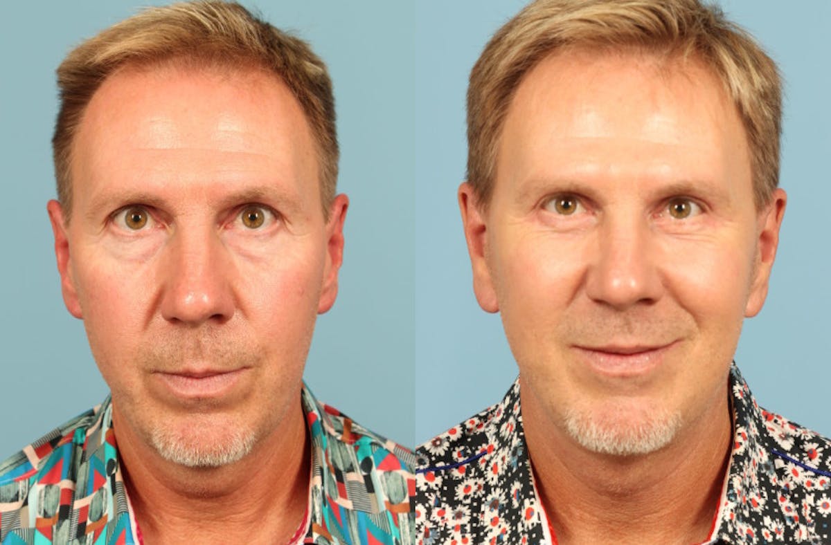 Neck Lift Before & After Gallery - Patient 293652 - Image 5
