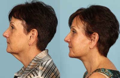 Neck Lift Before & After Gallery - Patient 209738 - Image 1