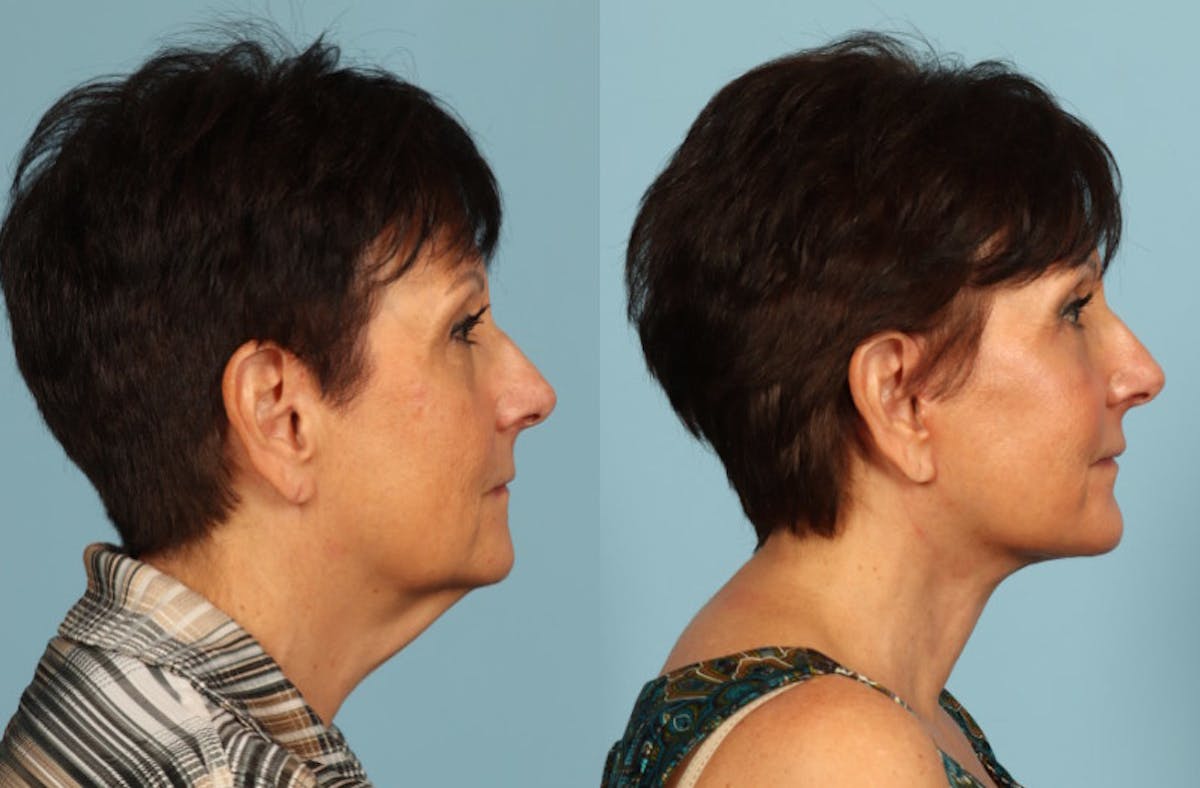 Neck Lift Before & After Gallery - Patient 209738 - Image 2