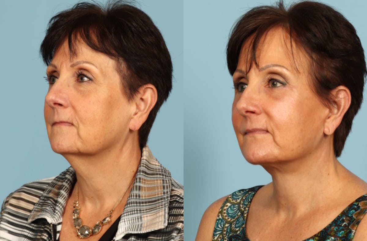 Neck Lift Before & After Gallery - Patient 209738 - Image 3