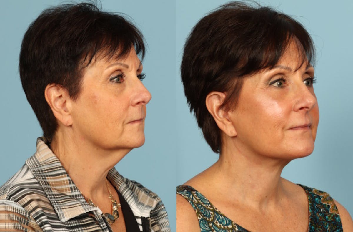 Neck Lift Before & After Gallery - Patient 209738 - Image 4