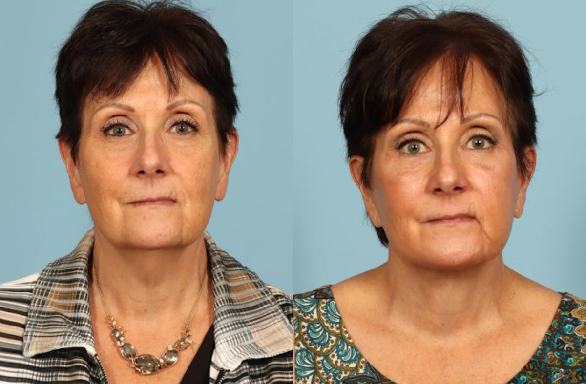 Neck Lift Before & After Gallery - Patient 209738 - Image 5