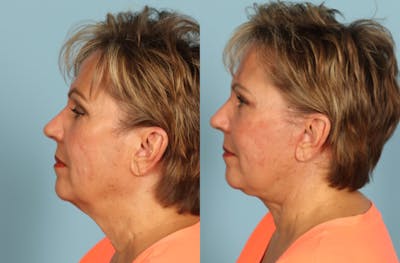 Neck Lift Before & After Gallery - Patient 640264 - Image 1