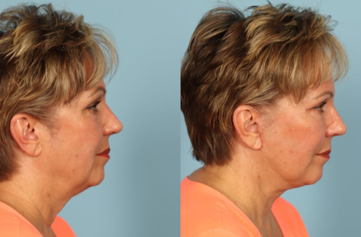 Neck Lift Before & After Gallery - Patient 640264 - Image 2