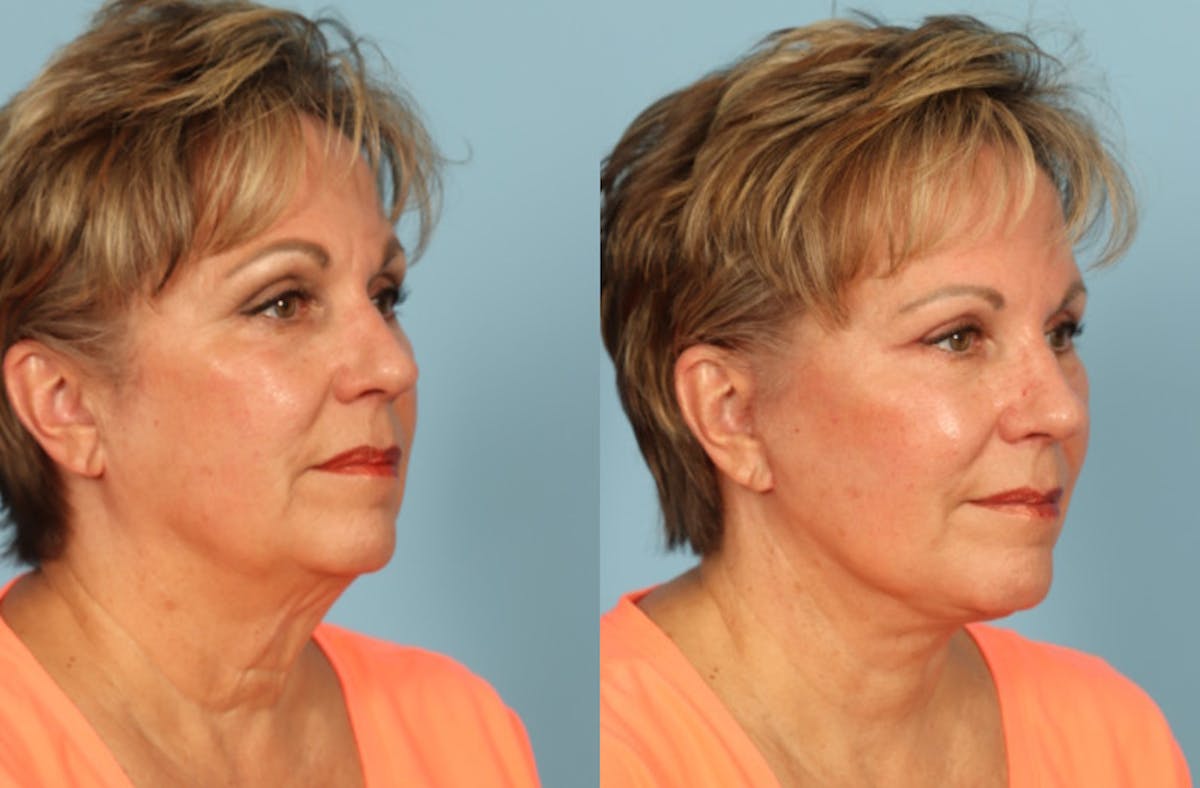 Neck Lift Before & After Gallery - Patient 640264 - Image 3