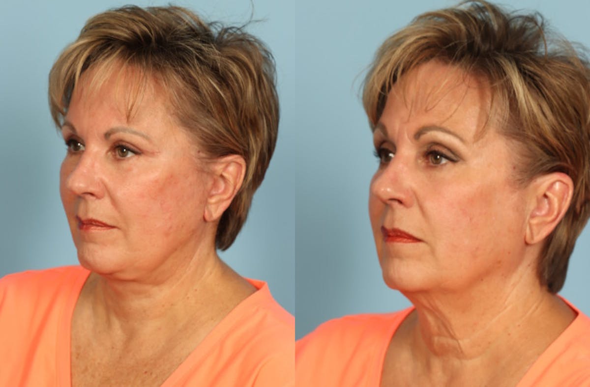 Neck Lift Before & After Gallery - Patient 640264 - Image 4