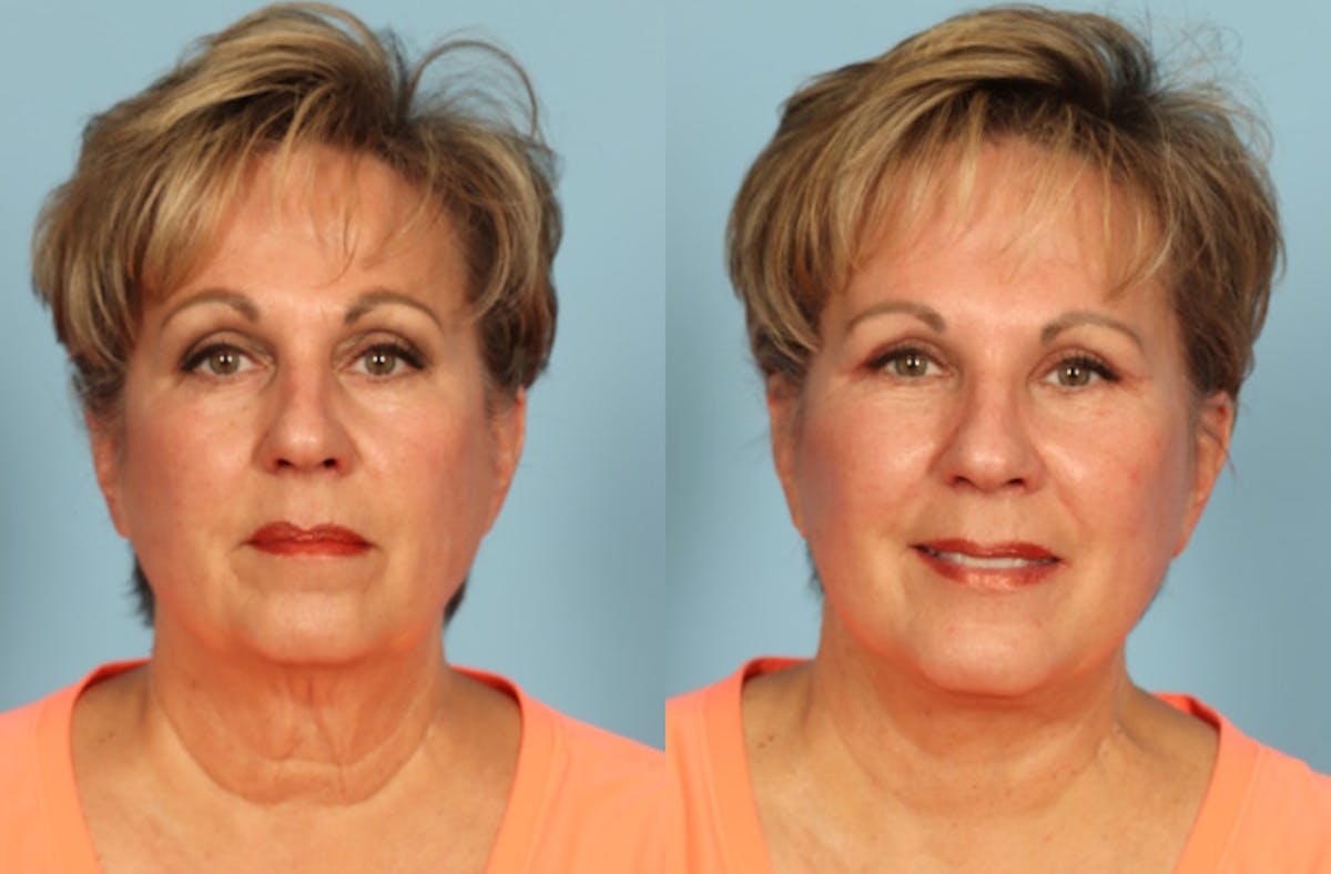 Neck Lift Before & After Gallery - Patient 640264 - Image 5