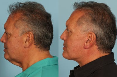 Neck Lift Before & After Gallery - Patient 589498 - Image 1