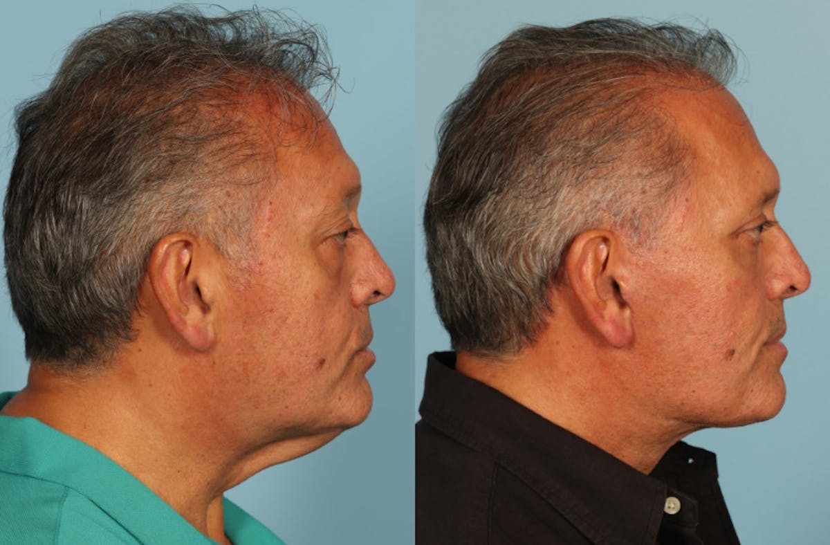 Neck Lift Before & After Gallery - Patient 589498 - Image 2