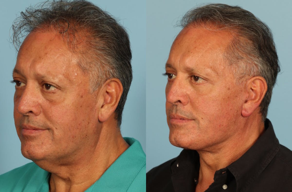 Neck Lift Before & After Gallery - Patient 589498 - Image 3