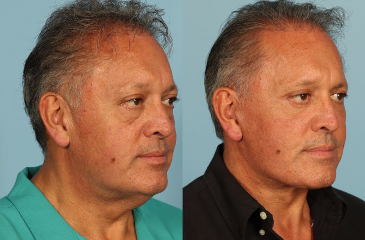 Neck Lift Before & After Gallery - Patient 589498 - Image 4