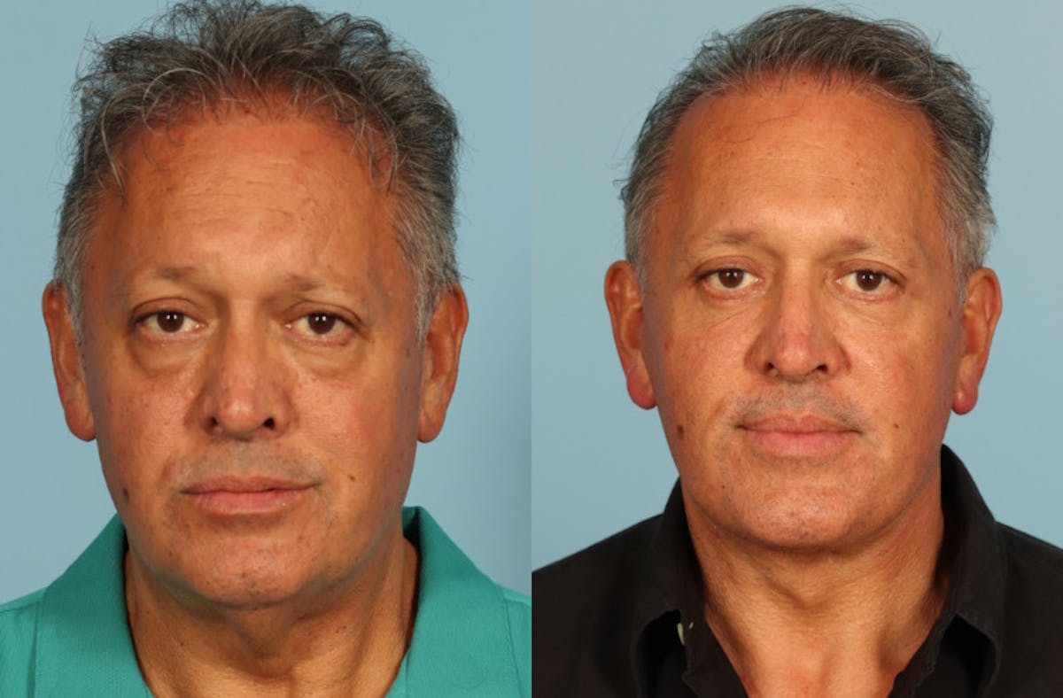 Neck Lift Before & After Gallery - Patient 589498 - Image 5