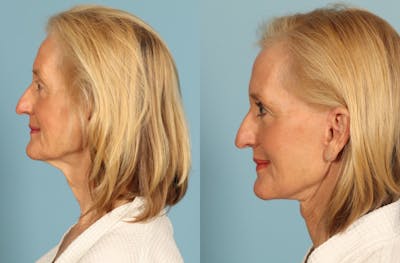 Neck Lift Before & After Gallery - Patient 403698 - Image 1
