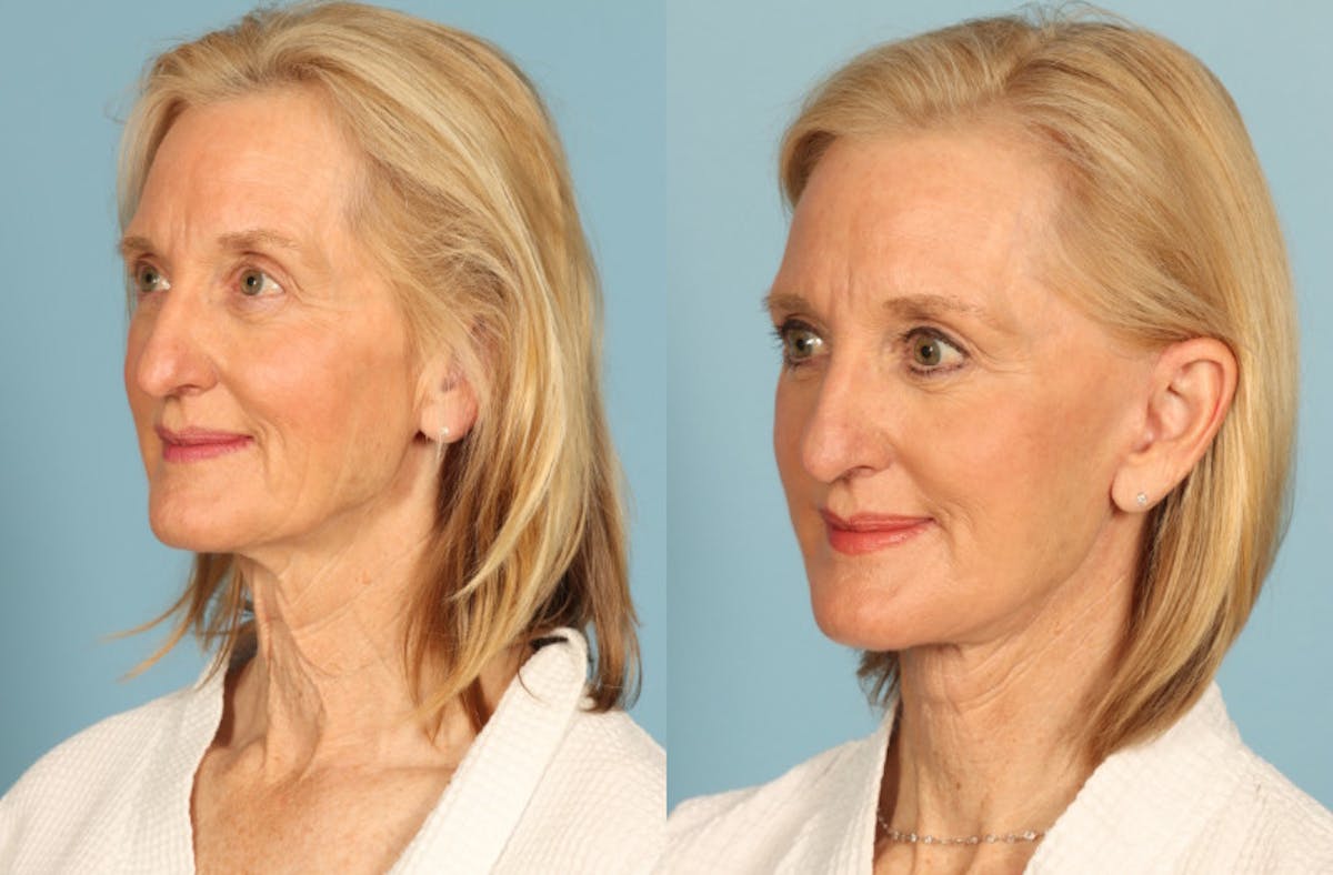 Neck Lift Before & After Gallery - Patient 403698 - Image 2