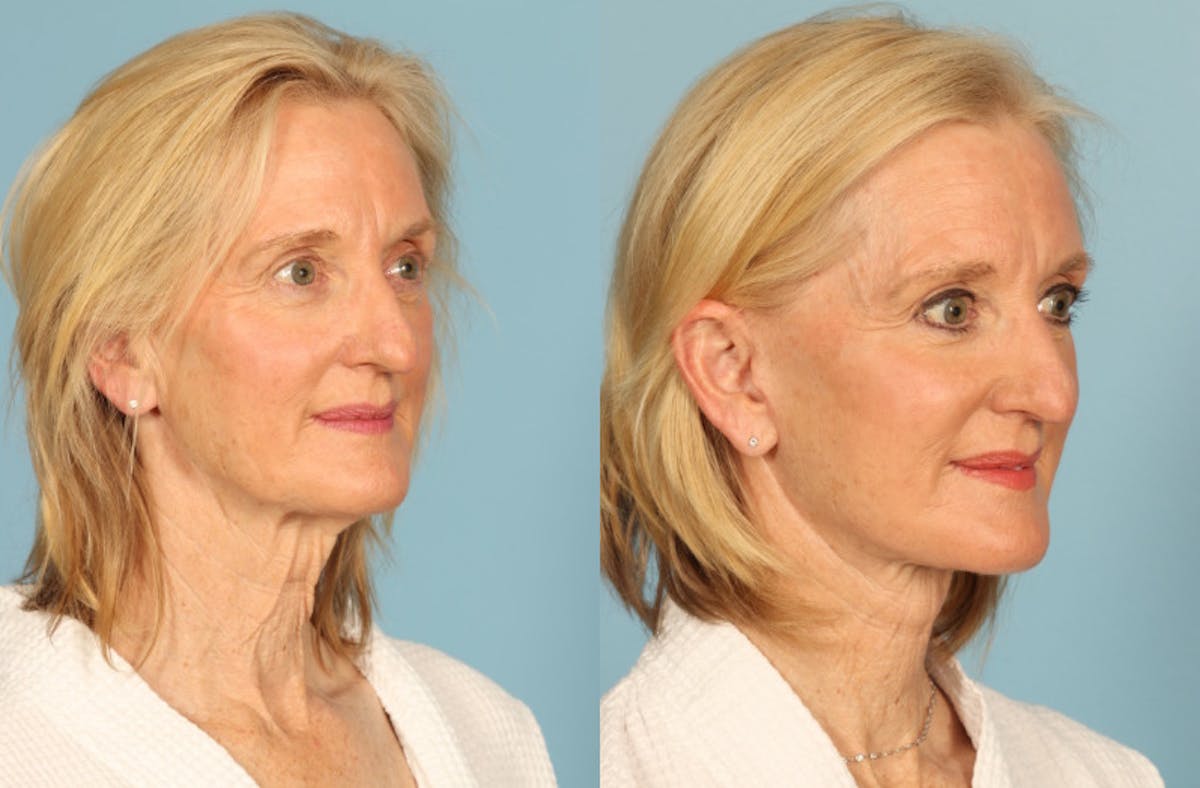 Neck Lift Before & After Gallery - Patient 403698 - Image 3