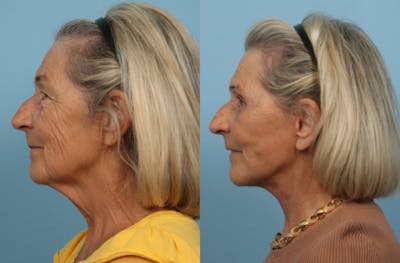 Neck Lift Before & After Gallery - Patient 381566 - Image 1