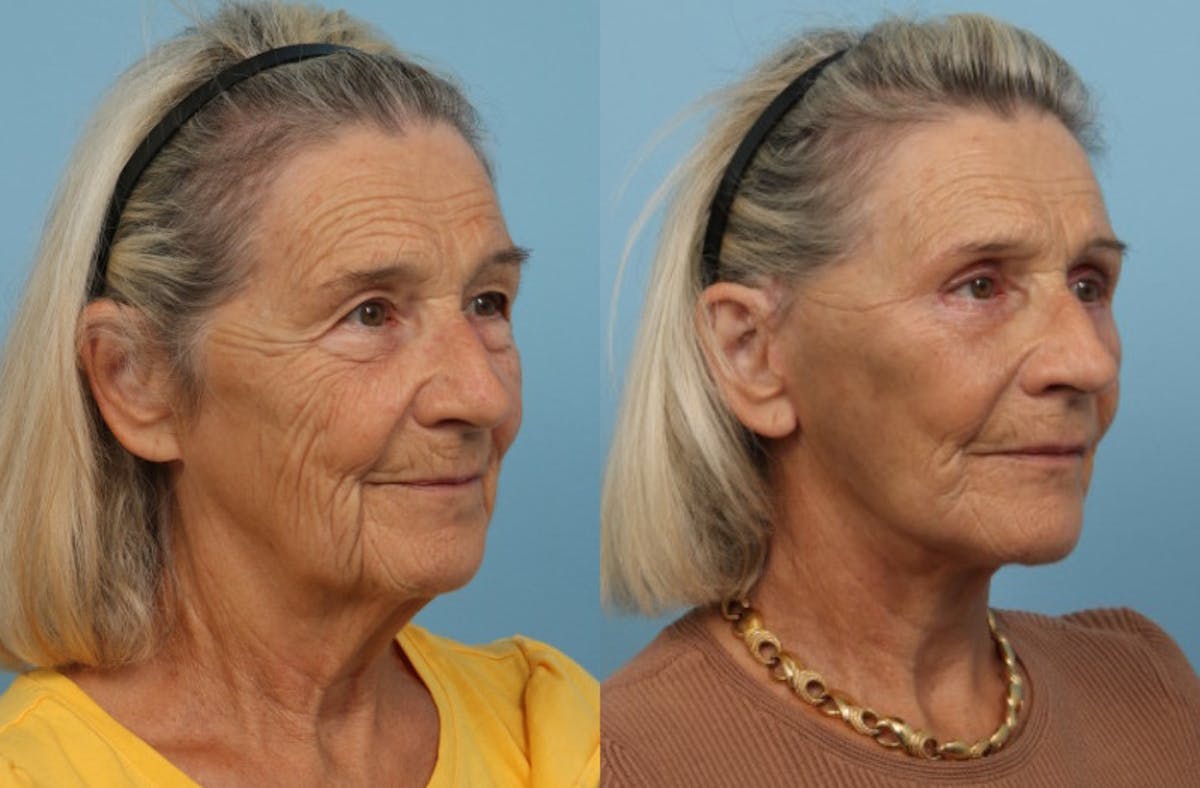 Neck Lift Before & After Gallery - Patient 381566 - Image 2