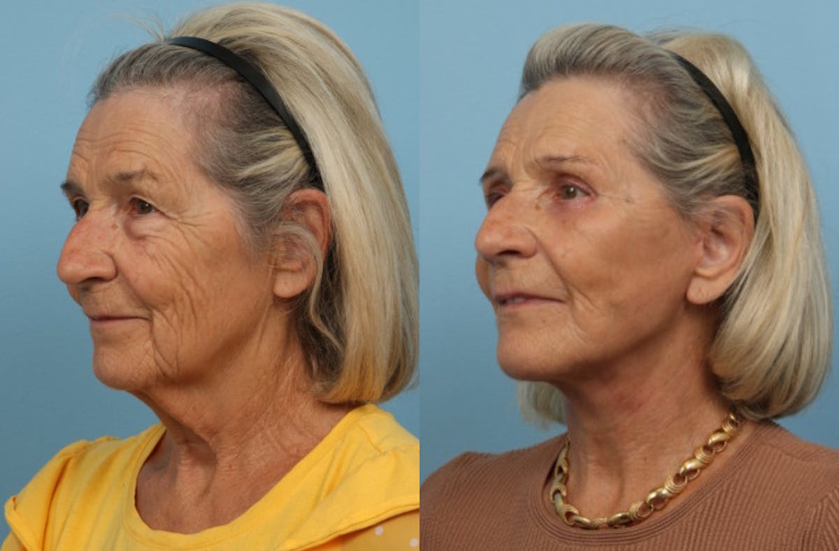 Neck Lift Before & After Gallery - Patient 381566 - Image 3
