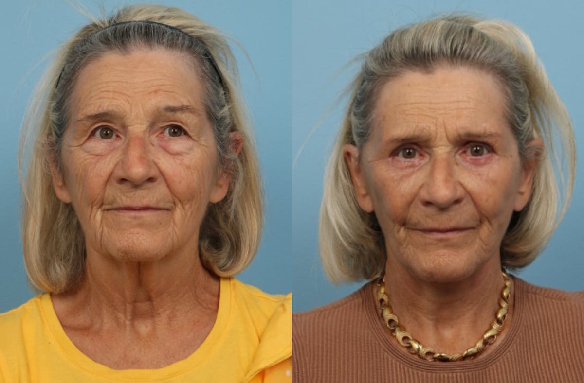 Neck Lift Before & After Gallery - Patient 381566 - Image 4