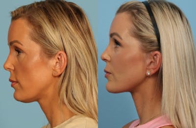 Neck Lift Before & After Gallery - Patient 140002 - Image 1