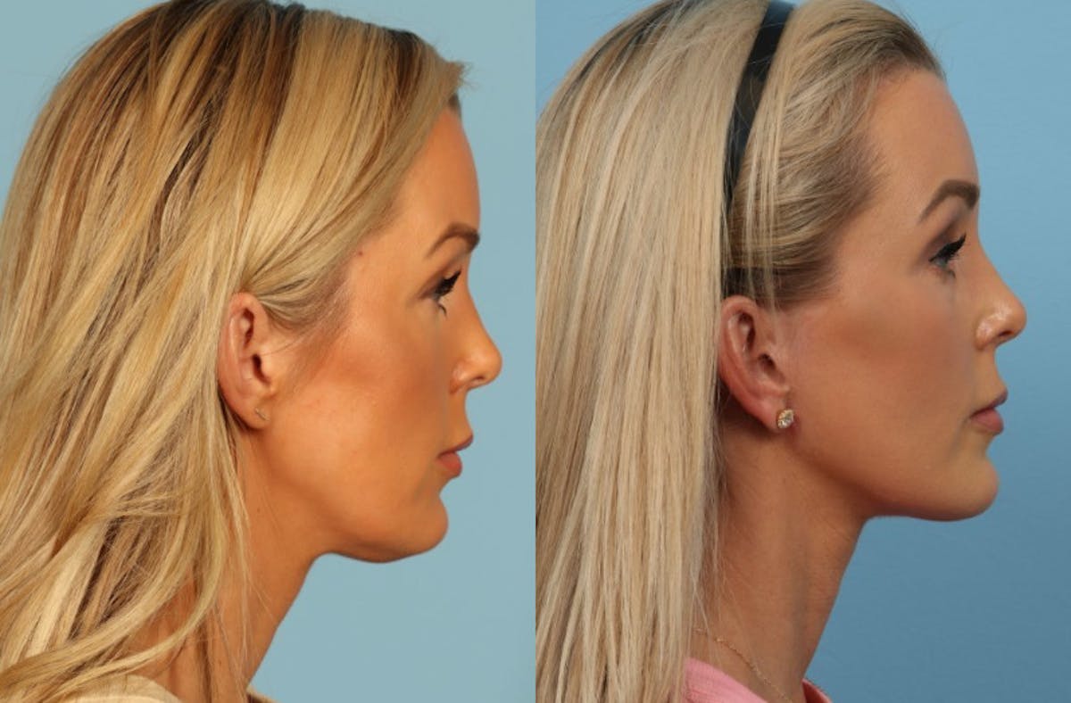 Neck Lift Before & After Gallery - Patient 140002 - Image 2