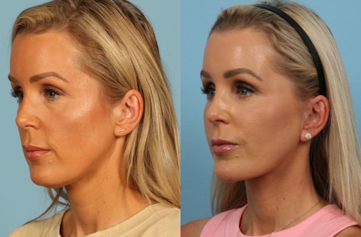 Neck Lift Before & After Gallery - Patient 140002 - Image 3
