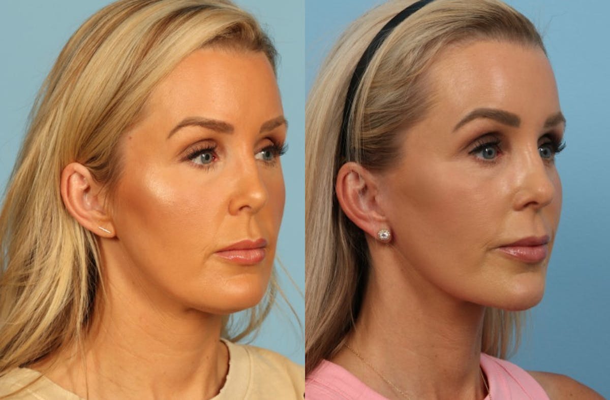 Neck Lift Before & After Gallery - Patient 140002 - Image 4
