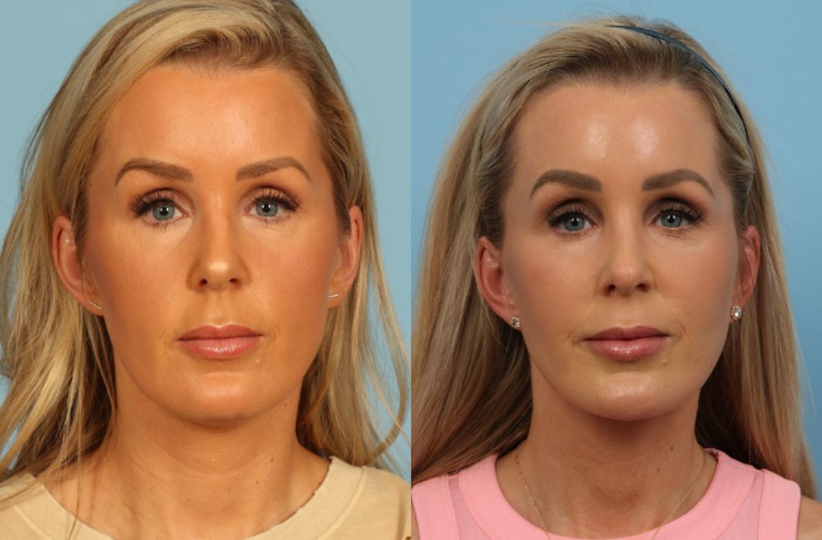 Neck Lift Before & After Gallery - Patient 140002 - Image 5