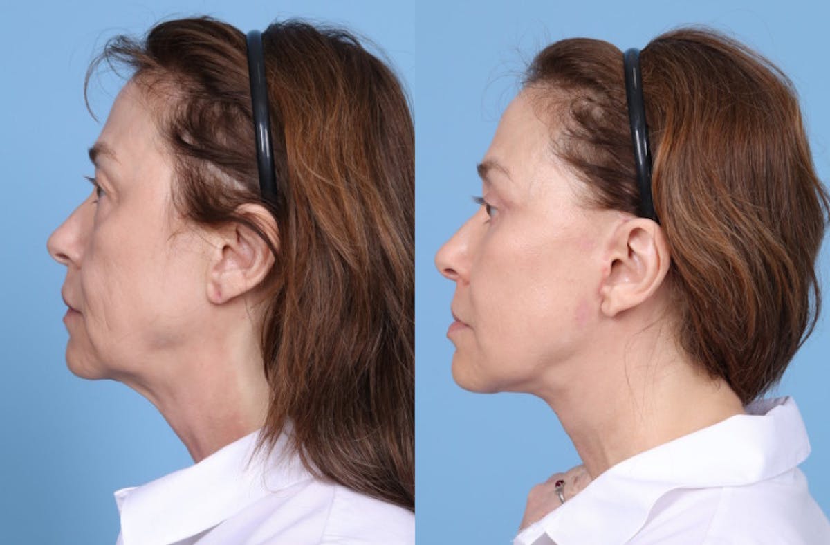 Neck Lift Before & After Gallery - Patient 905074 - Image 1