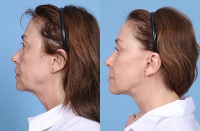 Neck Lift Before & After Gallery - Patient 905074 - Image 1