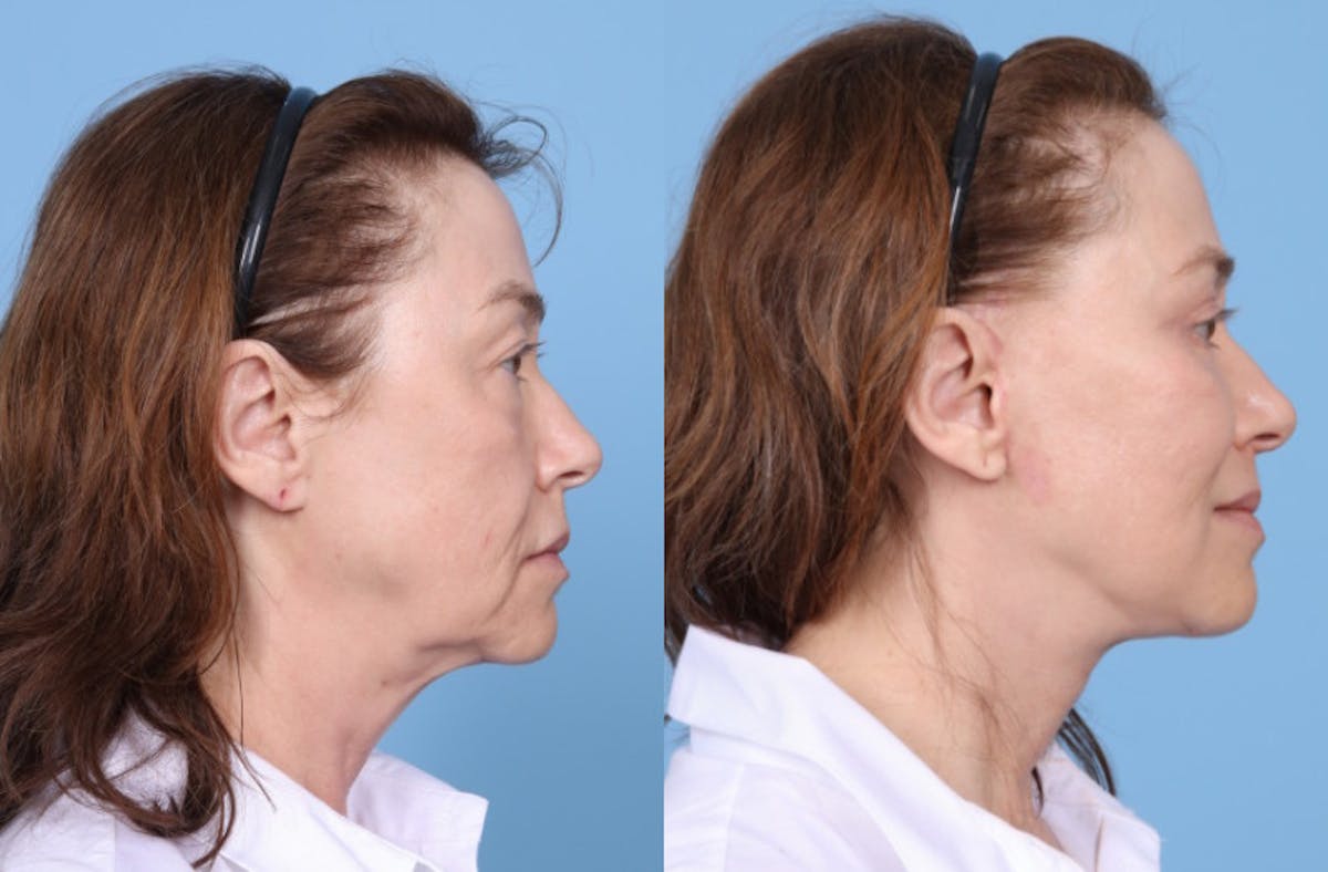 Neck Lift Before & After Gallery - Patient 905074 - Image 2