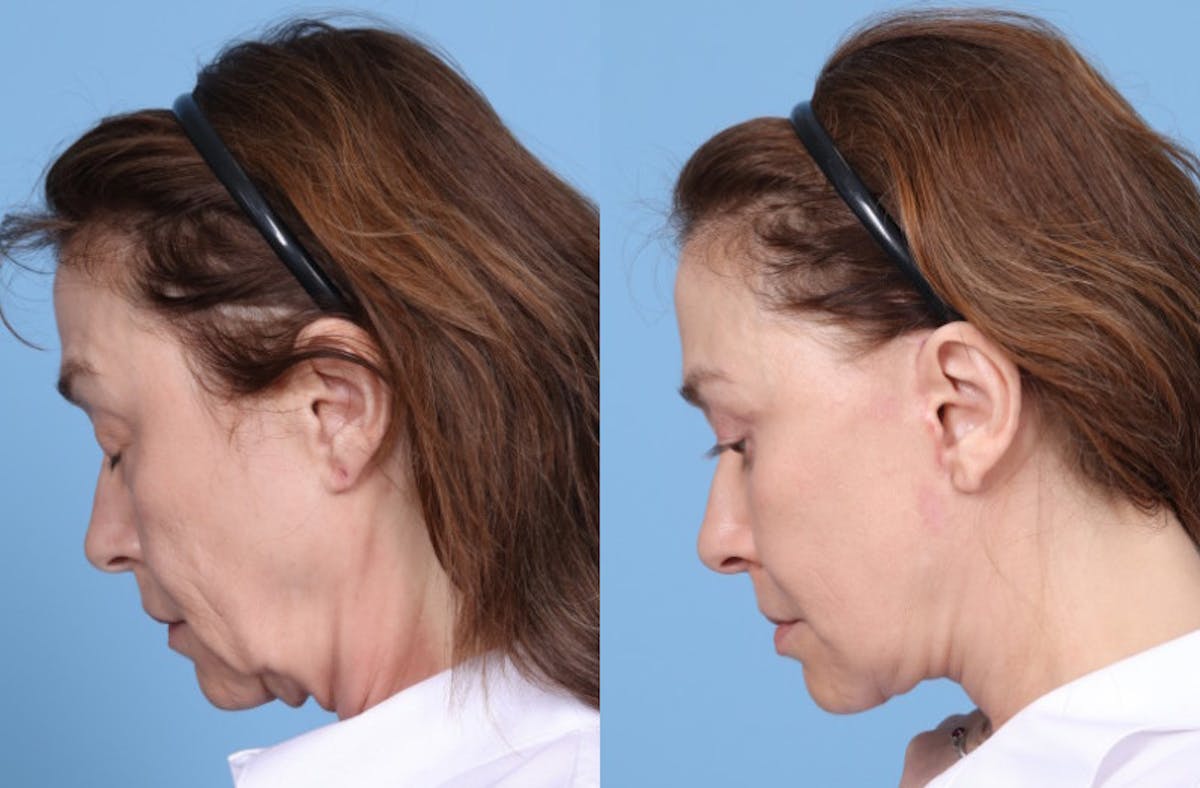 Neck Lift Before & After Gallery - Patient 905074 - Image 3