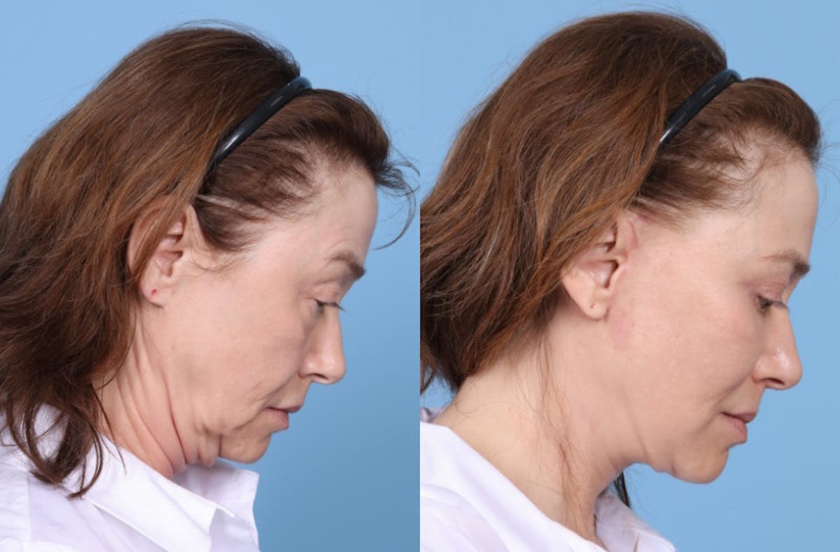 Neck Lift Before & After Gallery - Patient 905074 - Image 4
