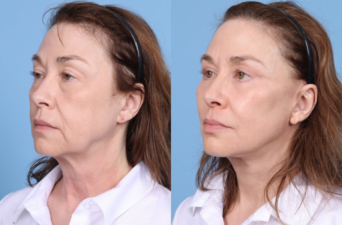 Neck Lift Before & After Gallery - Patient 905074 - Image 5