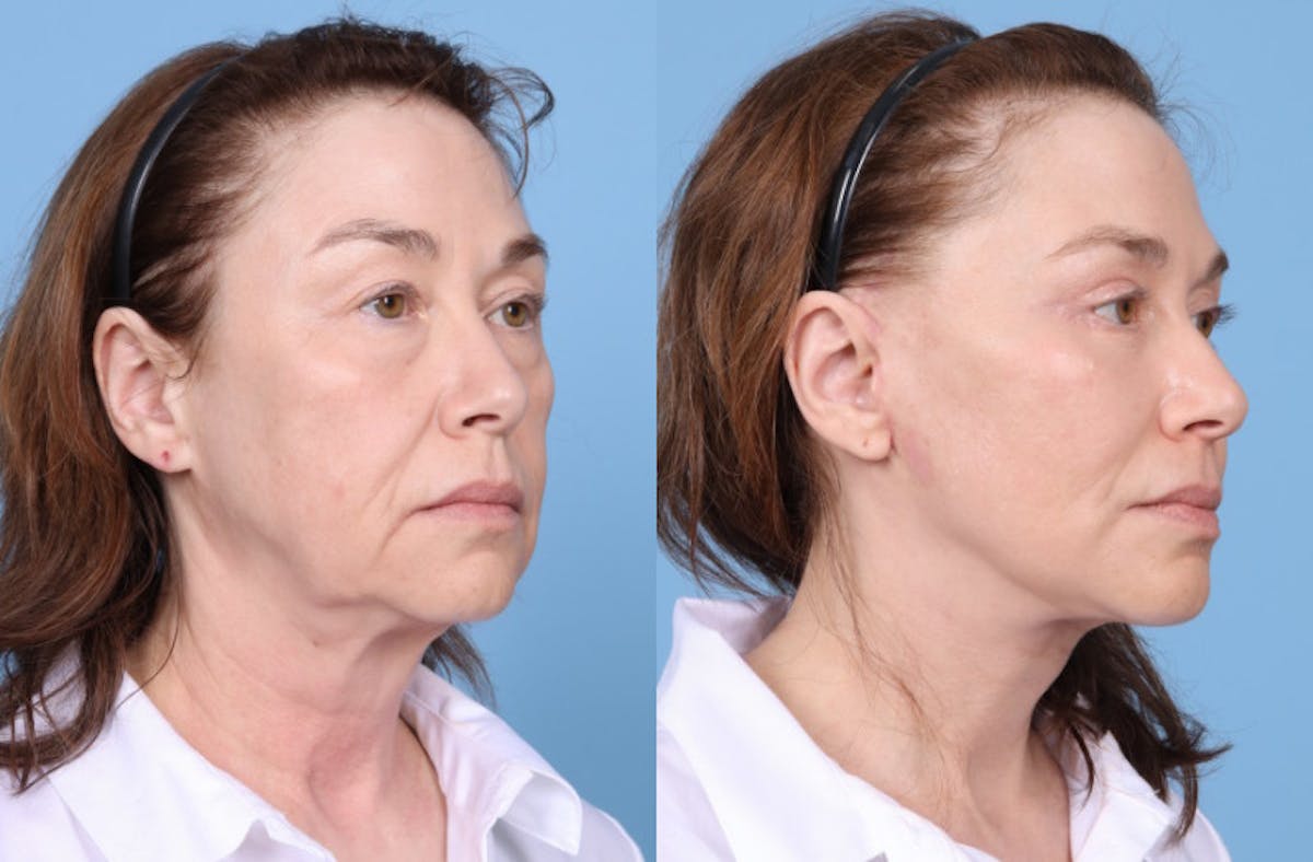 Neck Lift Before & After Gallery - Patient 905074 - Image 6